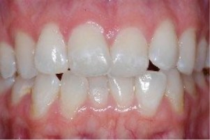 Mouth with small gaps between a few teeth