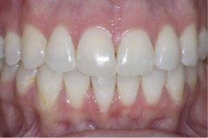 Mouth after closing small gaps between teeth