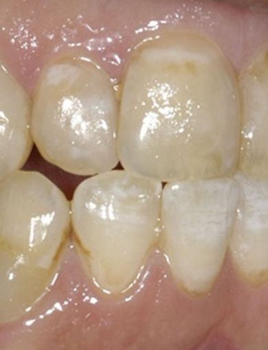 Close up of mouth after fixing tooth discoloration and damage