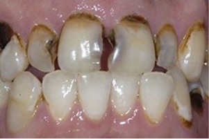 Close up of mouth with several damaged and discolored teeth