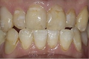 Close up of mouth after fixing tooth discoloration and damage