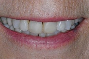 Mouth with small yellow stains on a few teeth