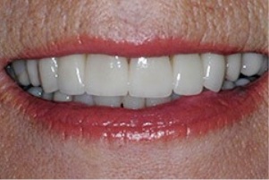 Mouth with no yellow stains on any teeth