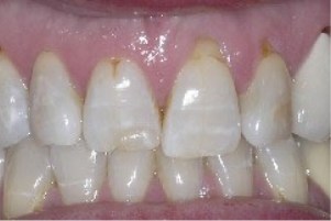 Mouth with receding gums on a few upper teeth