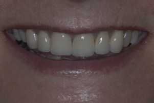 Close up of a smile with stainless white teeth
