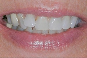 Mouth with slightly grayed teeth