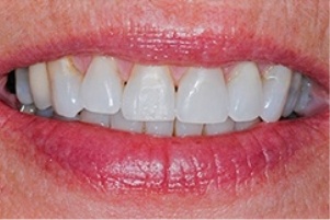 Mouth with much whiter teeth