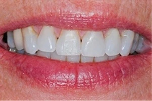 Teeth after treatment from Albuquerque dentist