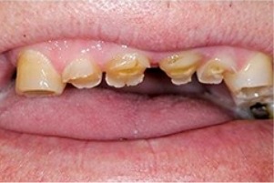 Mouth with multiple severely broken teeth