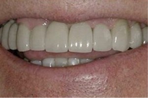 Mouth full of newly restored teeth