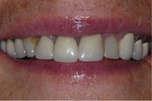 Smile with gray and yellow stains on several teeth