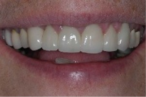 Smile with no stains on the teeth