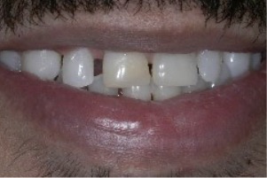 Mouth with slight gaps between a few teeth