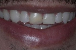 Mouth with no significant gaps between the teeth