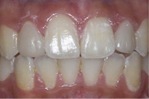 Mouth after fixing chipped teeth