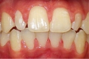 Mouth with a few chipped teeth