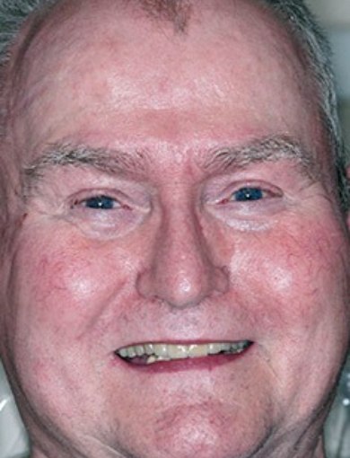 Dental patient Tom smiling