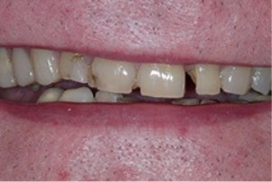 Mouth with a few broken teeth
