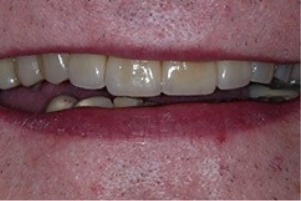 Mouth with broken teeth repaired