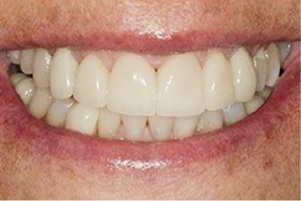 Mouth with significantly whiter and straighter teeth