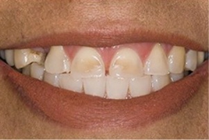 Mouth with stains on two front teeth