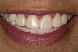 Mouth with no stains on front teeth