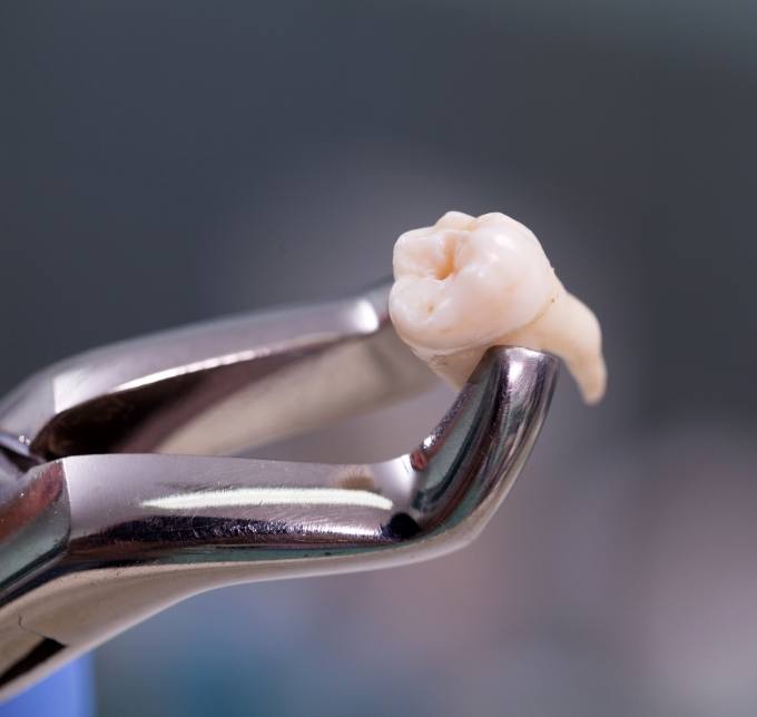 Forceps holding tooth after tooth extraction in Albuquerque