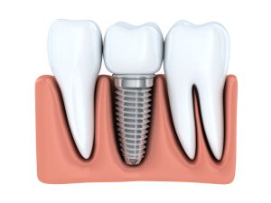 Your dentist in Albuquerque discusses replacement for your missing tooth.