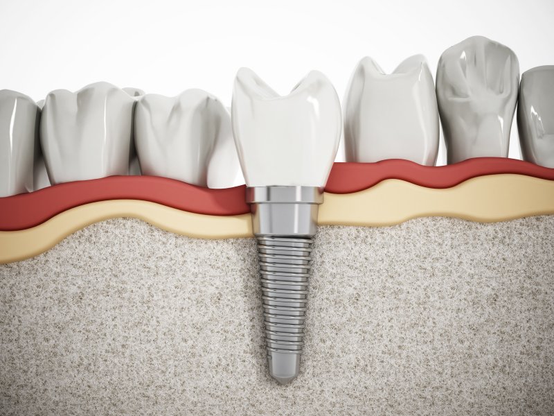 a single dental implant in the lower arch