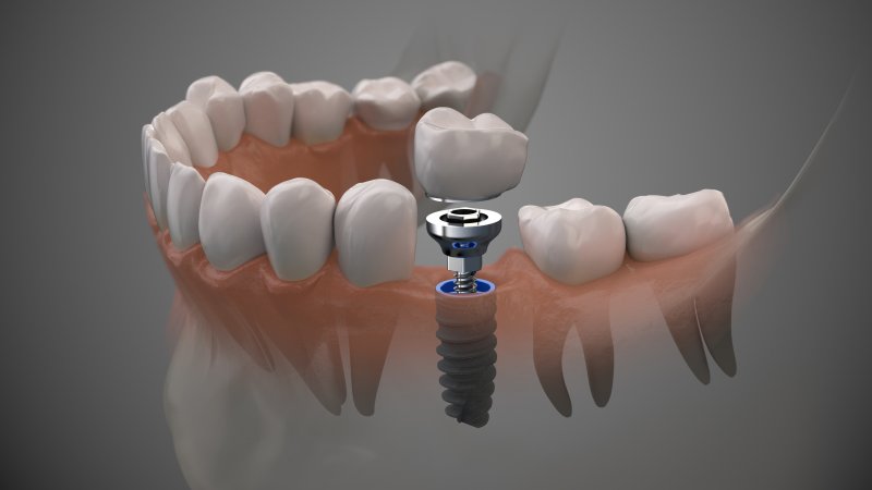 a dental implant in Albuquerque