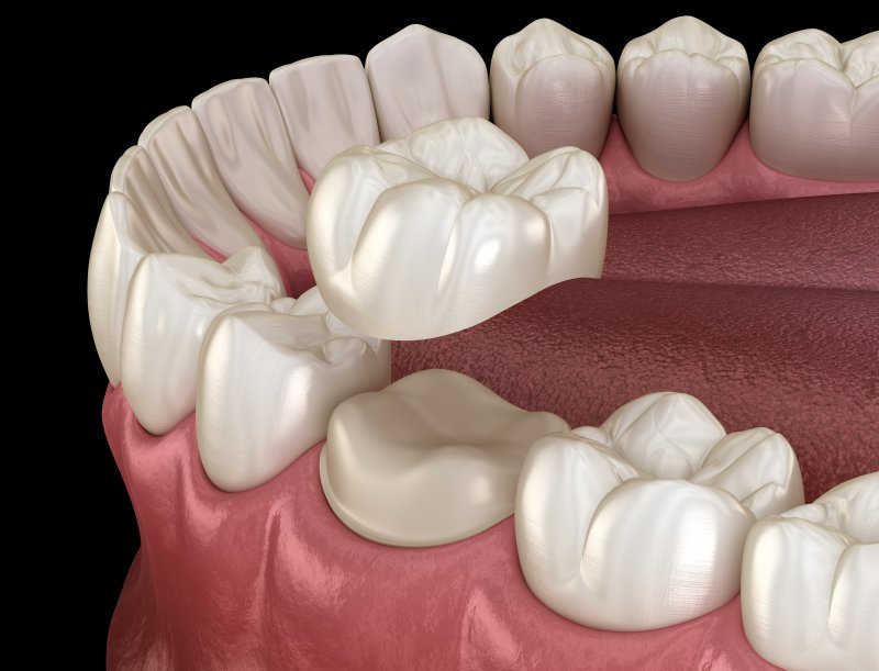 a single dental crown