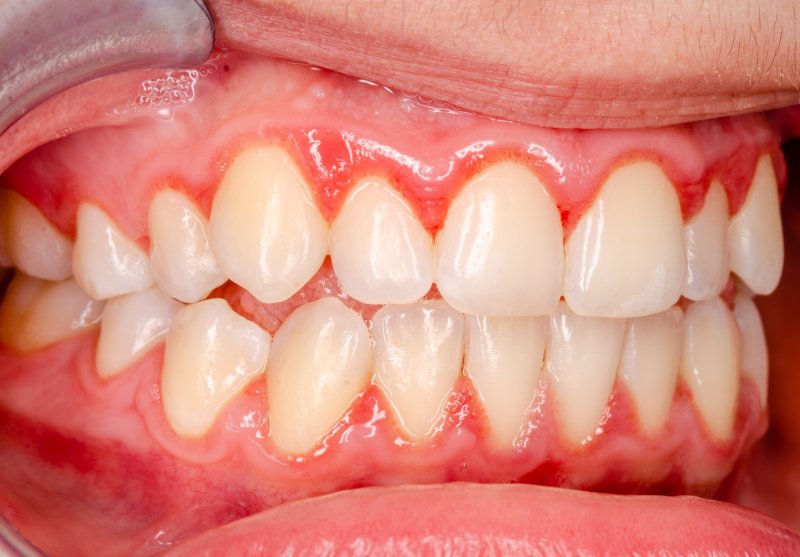 person with gingivitis