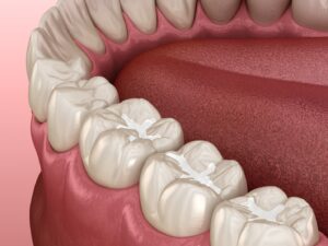 digital image of a tooth-colored filling